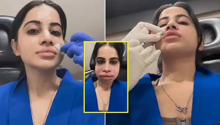 ಊದಿದ ಮುಖ.. ಉರ್ಫಿಗೆ ಏನಾಯ್ತು?  – ಲಿಪ್ ಸರ್ಜರಿ.. ಬ್ಯೂಟಿ  ಕಳ್ಕೊಂಡ್ರಾ?