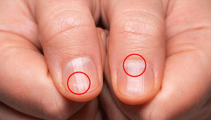 ದೇಹದಲ್ಲಿ ಈ ಲಕ್ಷಣ ಕಂಡುಬಂದ್ರೆ ಹುಷಾರ್! – ಉಗುರಿನಲ್ಲಿದೆ ನಿಮ್ಮ ಆರೋಗ್ಯದ ಗುಟ್ಟು!