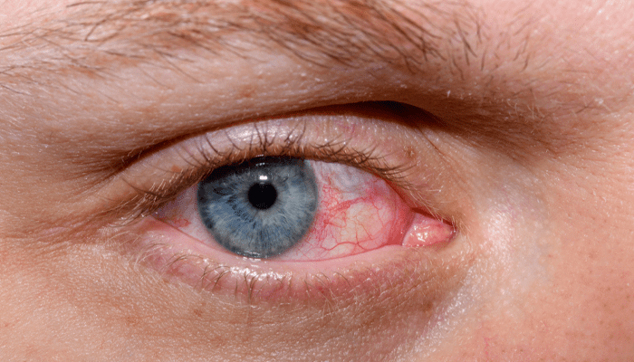 ಈ ತಪ್ಪು ಮಾಡಿದ್ರೆ ನಿಮ್ಮನ್ನ ಕಾಡುತ್ತೆ ಡ್ರೈ ಐ ಸಿಂಡ್ರೋಮ್! – ನಿಮ್ಮ ಕಣ್ಣು ಜೋಪಾನ!