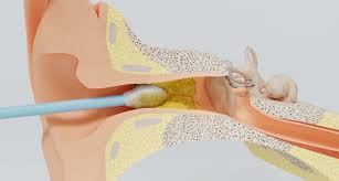 ಕಾಟನ್ ಸ್ಟಿಕ್ ಬಳಸಿ ಕಿವಿಯನ್ನು ಸ್ವಚ್ಛ ಮಾಡ್ತೀರಾ – ಈ ಸ್ಪೋರಿಯನ್ನ ತಪ್ಪದೇ ಓದಿ