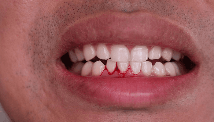 ಹಲ್ಲಿನ ವಸಡಿನಲ್ಲಿ ರಕ್ತ ಬರ್ತಿದ್ಯಾ? – ಈ ಮನೆಮದ್ದು ಟ್ರೈ ಮಾಡಿ!