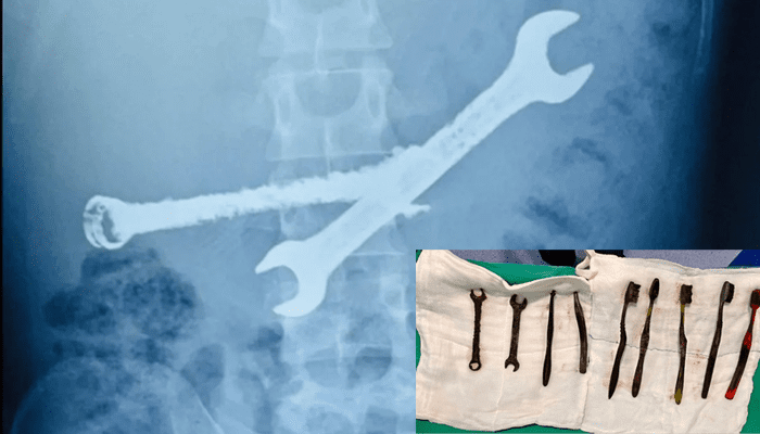 ಅಬ್ಬಬ್ಬಾ.. ಬಾಲಕನ ಹೊಟ್ಟೆಯಲ್ಲಿತ್ತು ಸ್ಪ್ಯಾನರ್‌, 7 ಬ್ರಶ್‌ಗಳು!