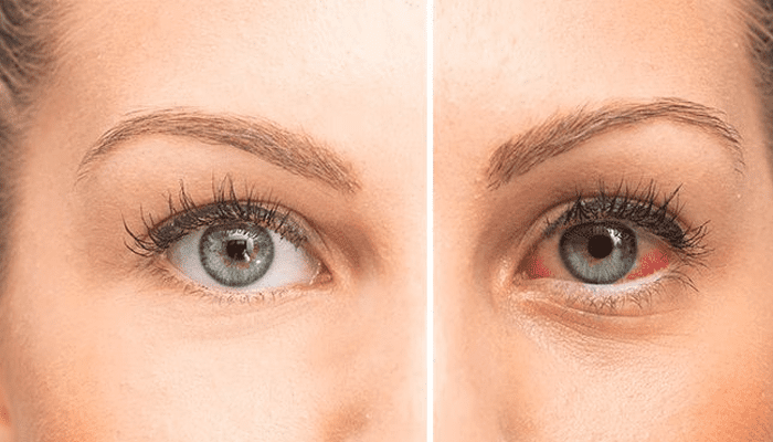 ಪದೇ ಪದೆ ಕಣ್ಣಿನಲ್ಲಿ ಈ ಸಮಸ್ಯೆ ಕಾಣಿಸಿಕೊಳ್ಳುತ್ತಾ? – ಎಚ್ಚರ.. ನಿಮ್ಮನ್ನ ಈ ಸಮಸ್ಯೆ ಕಾಡುತ್ತಿರಬಹುದು!