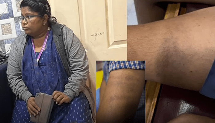 ಬಾಲಕನಿಗೆ ಮನಬಂದಂತೆ ಥಳಿಸಿದ ಶಿಕ್ಷಕಿ! – ಮನೆಯಲ್ಲಿ ಹೇಳಿದ್ರೆ ಕುತ್ತಿಗೆ ಹಿಸುಕುತ್ತೇನೆ ಎಂದು ಧಮ್ಕಿ!