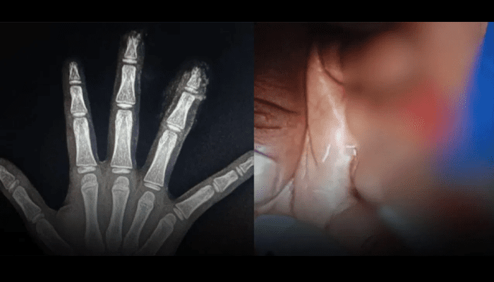 ಶಾಲೆಯಲ್ಲಿ ವಿದ್ಯಾರ್ಥಿನಿ ಬೆರಳುಗಳೇ ಕಟ್! –  ಮಗಳ ಬಗ್ಗೆ ಪ್ರಶ್ನಿಸಿದ್ದಕ್ಕೆ 2 ಸಾವಿರ ಕೊಟ್ಟು ಕಳುಹಿಸಿದ ಶಿಕ್ಷಕರು!