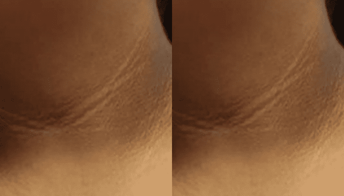 ಕುತ್ತಿಗೆಯಲ್ಲಿ ಕಪ್ಪು ಕಲೆ ಇದ್ಯಾ? – ಈ ಮನೆ ಮದ್ದು ಟ್ರೈ ಮಾಡಿದ್ರೆ ಬೇಗನೆ ಹೋಗುತ್ತೆ ಕಲೆ!