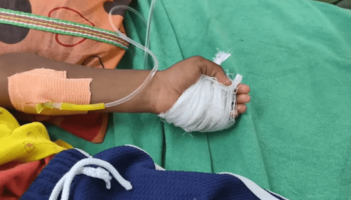 ಬಲಗೈ ಬದಲು ಬಾಲಕನ ಎಡಗೈ ಆಪರೇಷನ್‌! – ಅಯ್ಯೋ.. ವೈದ್ಯರ ಎಡವಟ್ಟಿಗೆ ಬೆರಳೇ ಕಟ್!‌